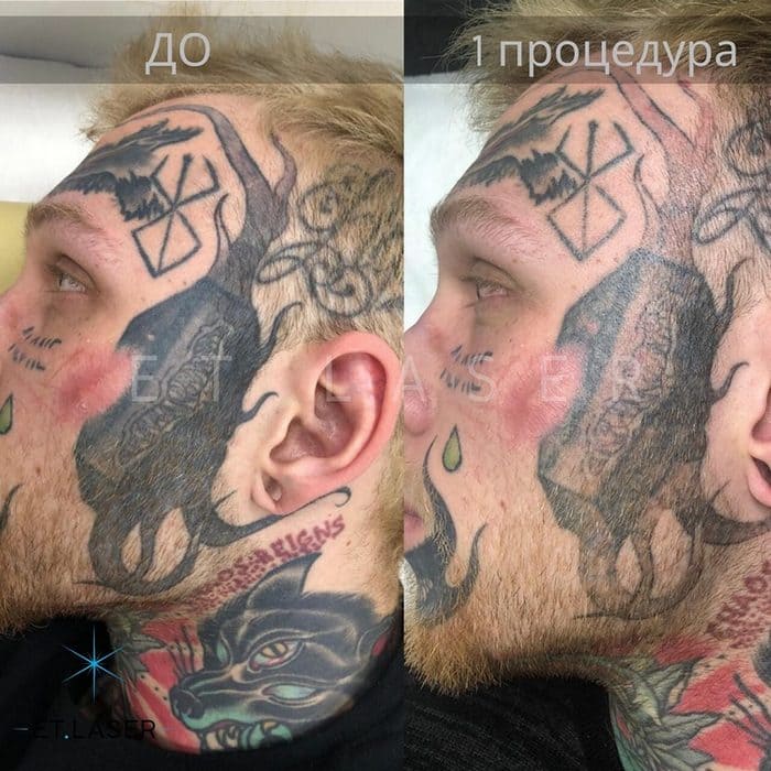 Денис Шальных удалил татуировки